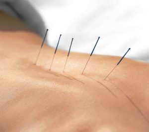 Akupunkturnadeln im Rücken